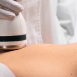 Microondas Selectivas contra la Celulitis y la Flacidez sin Cirugía