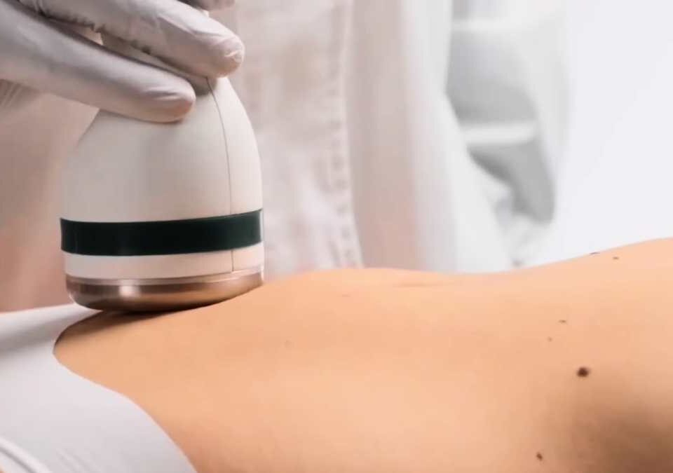 Microondas Selectivas contra la Celulitis y la Flacidez sin Cirugía