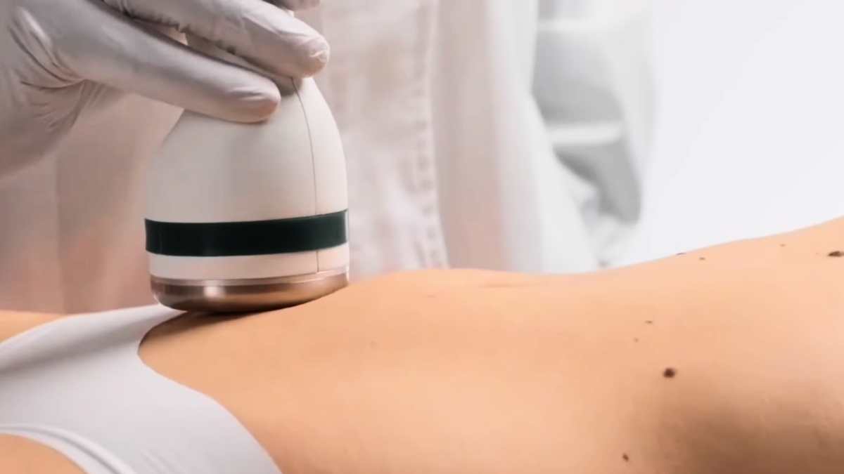 Microondas Selectivas contra la Celulitis y la Flacidez sin Cirugía